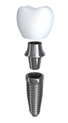 Implant-Prosmile