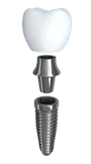 Implant-Prosmile